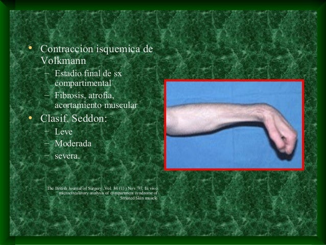 contractura de volkman